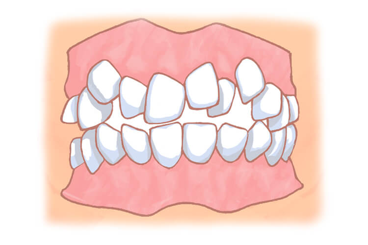 叢生・乱ぐい歯・八重歯
