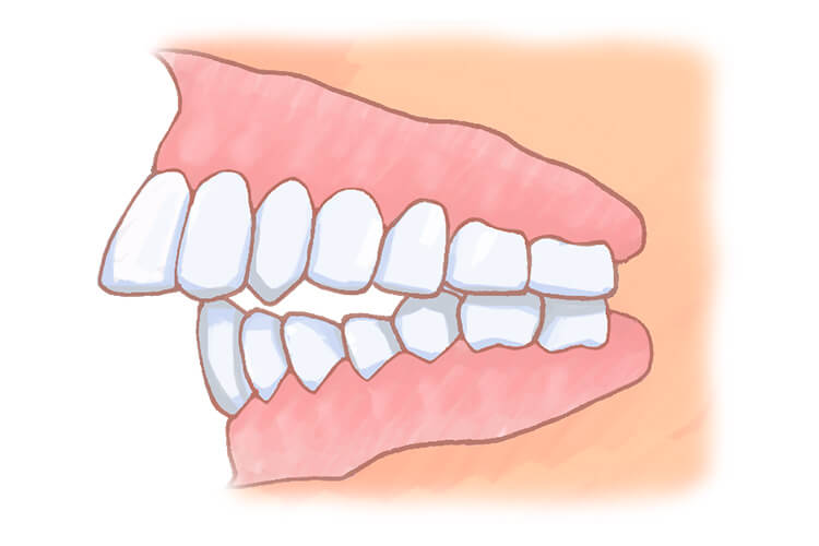 上顎前突（出っ歯）